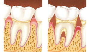 doenca_periodontal