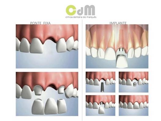 Placa para bruxismo defeituosa pode trazer problemas além dos dentes.